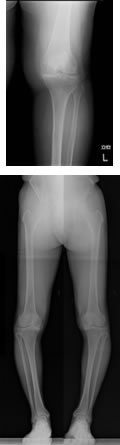 人工膝関節（術前）の写真