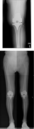 人工膝関節（術後）の写真